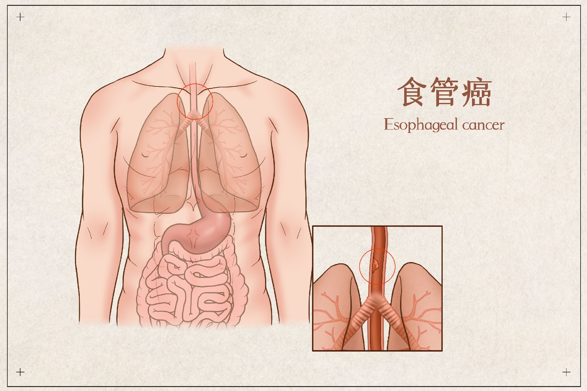 摄图网_401863169_食管癌医疗插画（企业商用）.jpg