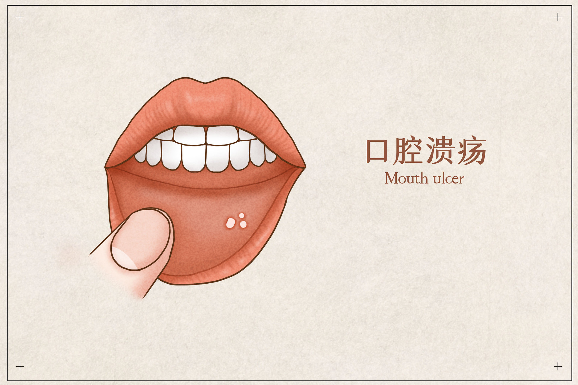 摄图网_401788992_banner_口腔溃疡医疗插画示意图（企业商用）.jpg
