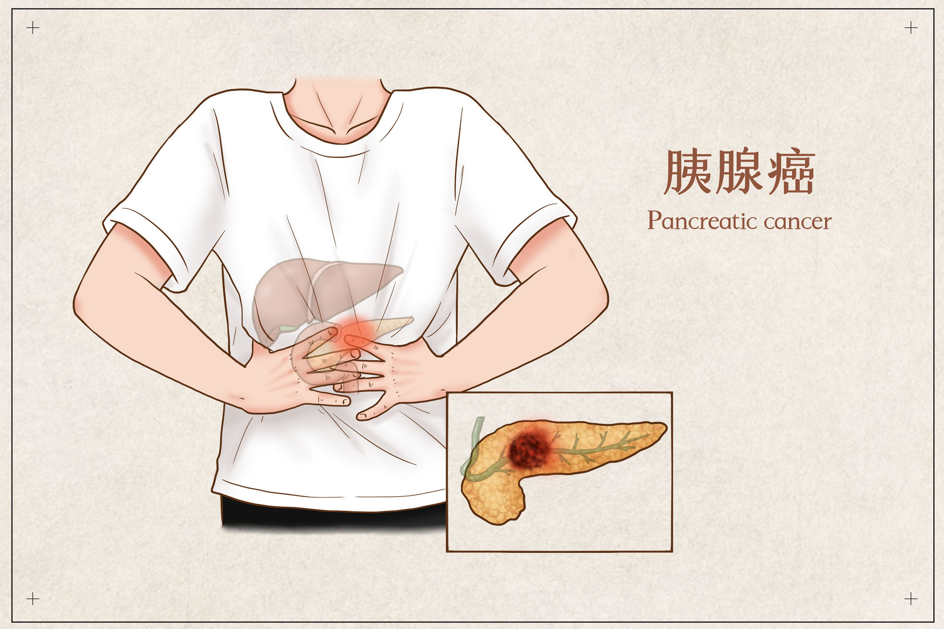摄图网_401795368_banner_胰腺癌医疗插画（企业商用）.jpg