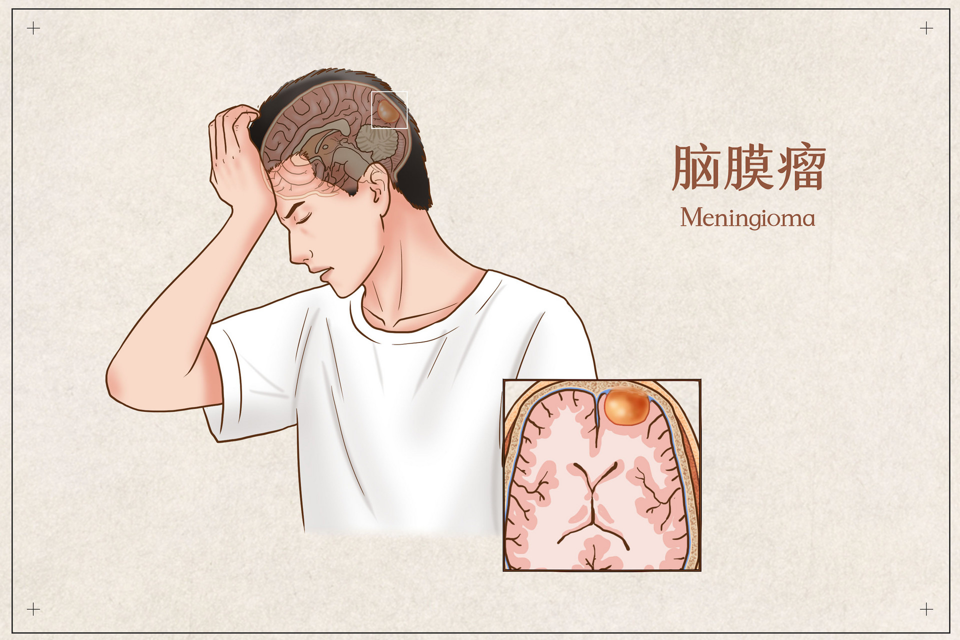 摄图网_401796585_脑膜瘤医疗插画(企业商用).jpg