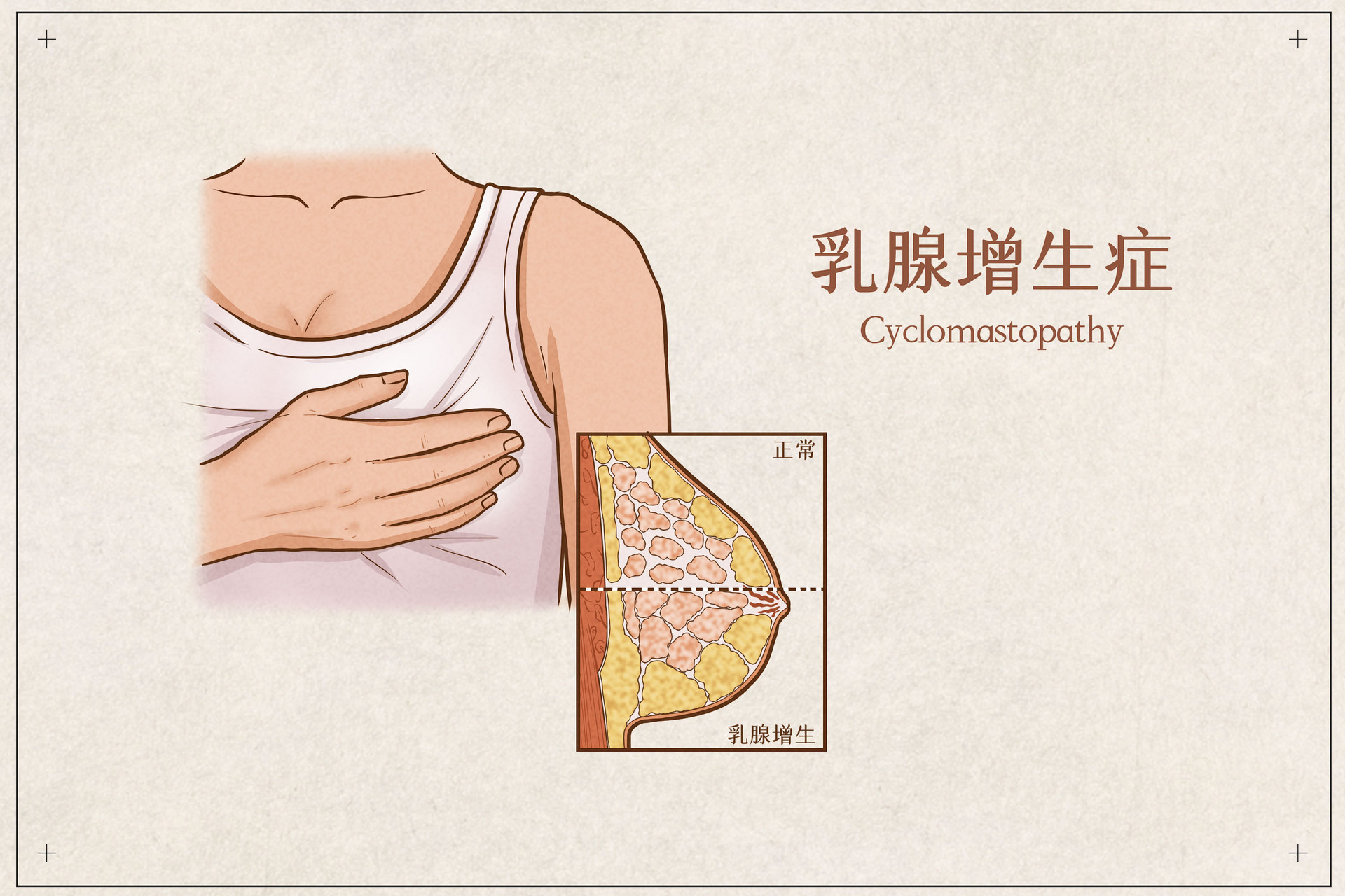 摄图网_401789466_banner_乳腺增生症医疗插画示意图（企业商用）.jpg