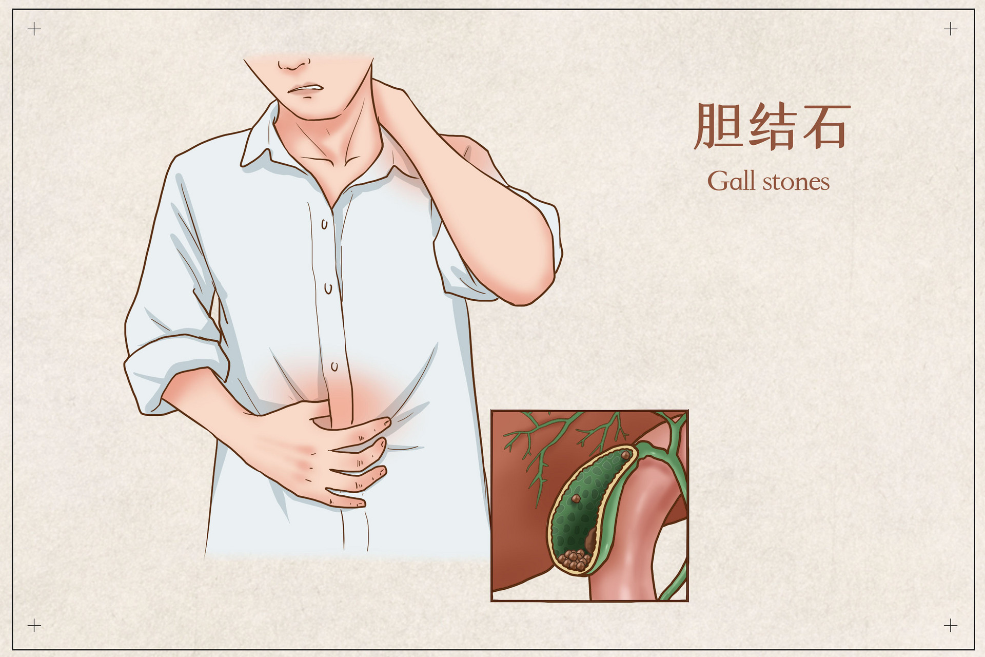 摄图网_401804065_banner_胆结石医疗插画（企业商用）.jpg