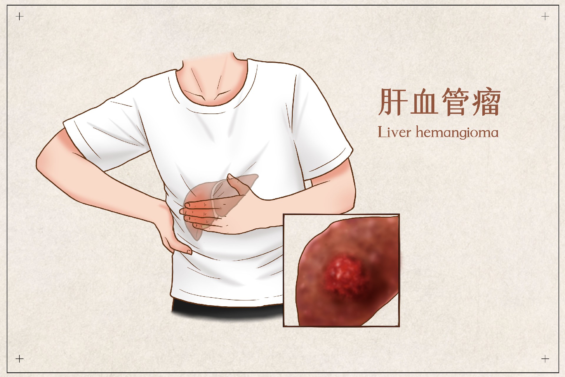 摄图网_401795364_肝血管瘤医疗插画（企业商用）.jpg