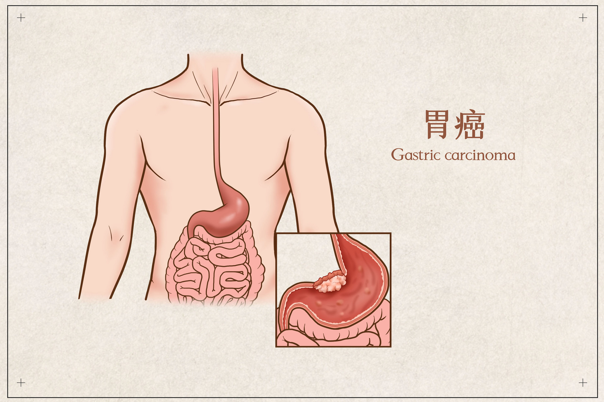 摄图网_401789678_banner_胃癌医疗插画（企业商用）.jpg