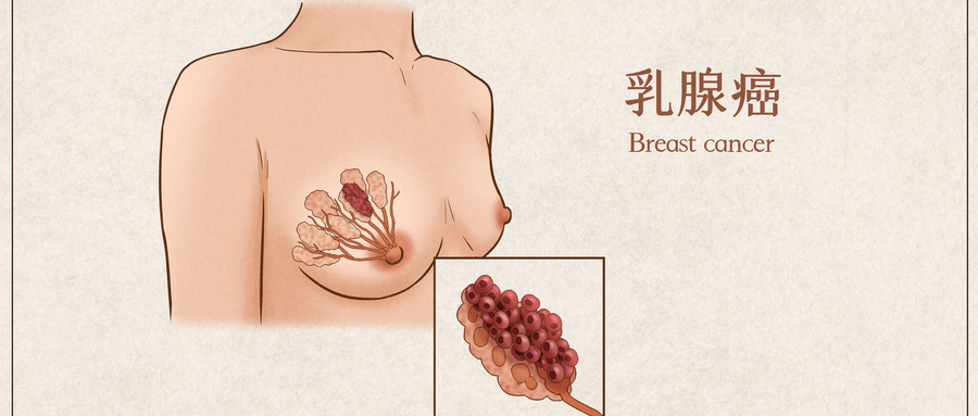 摄图网_401789478_wx_乳腺癌医疗插画示意图（企业商用）.jpg