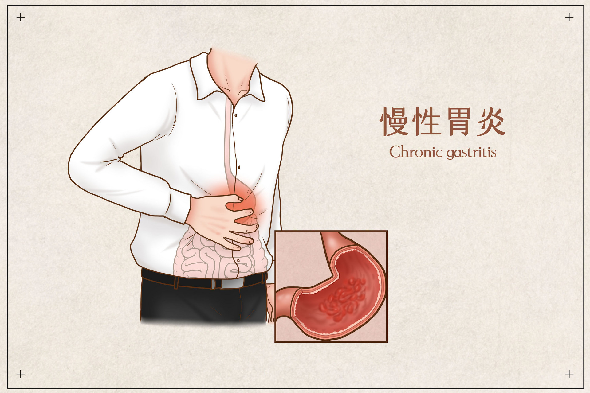 摄图网_401789711_banner_慢性胃炎医疗插画（企业商用）.jpg