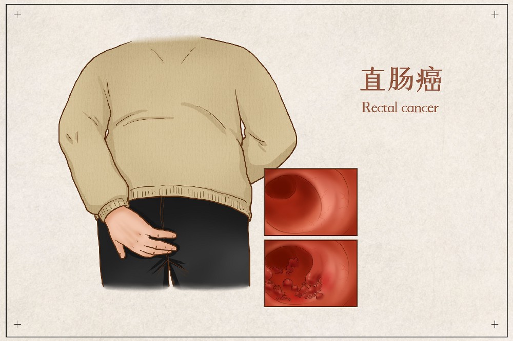 摄图网_401799665_banner_直肠癌医疗插画（企业商用）.jpg