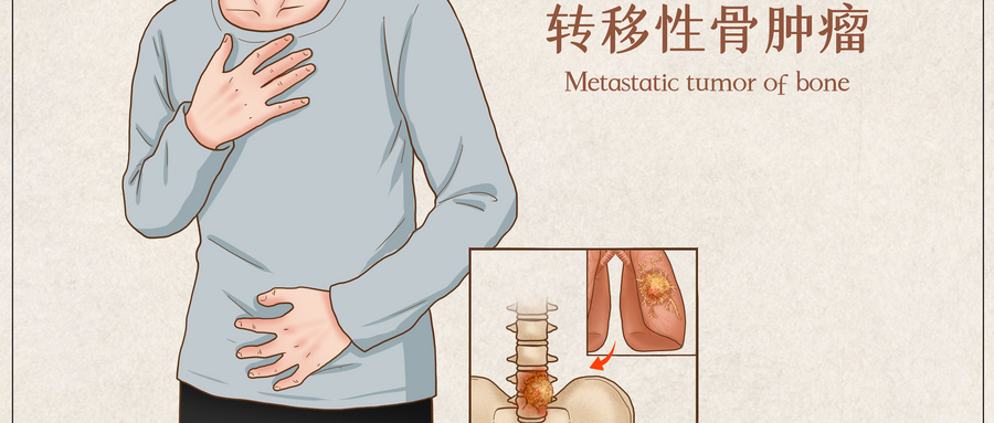 摄图网_401866611_wx_转移性骨肿瘤医疗插画（企业商用）.jpg